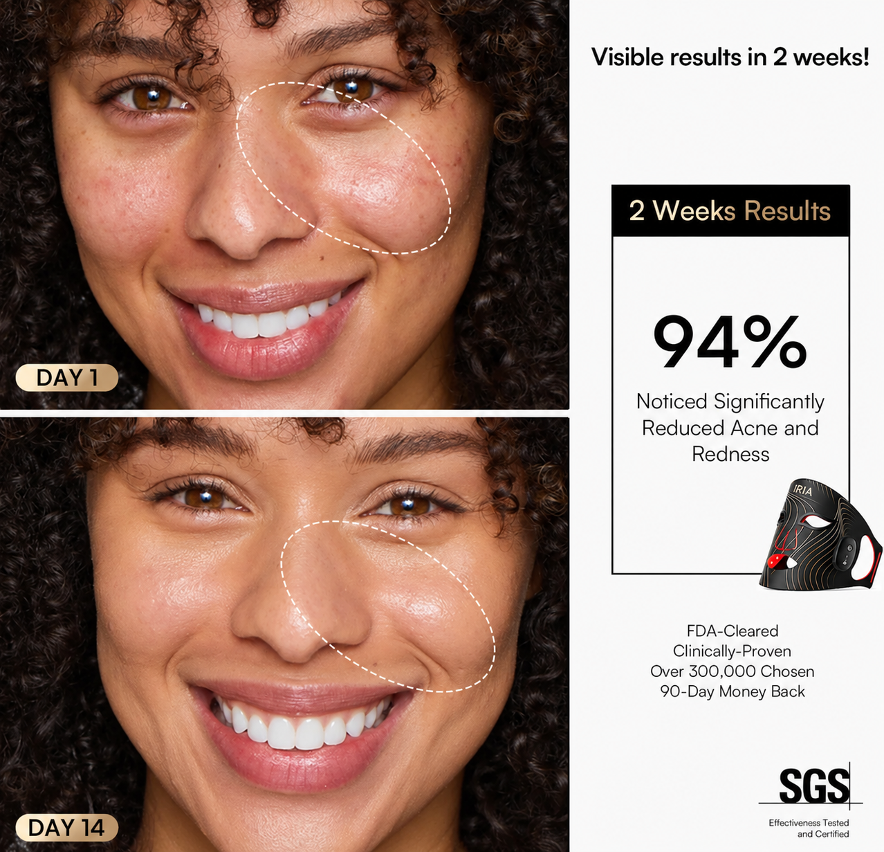 Day 1 vs Day 14 — 94% noticed reduced acne and redness